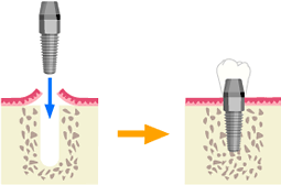 インプラント手術 ─ 2回法