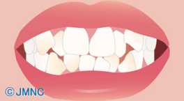歯並びの悪さが及ぼす影響