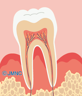 歯周病とは