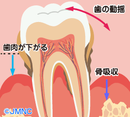 歯周炎