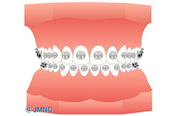 金属ブラケット