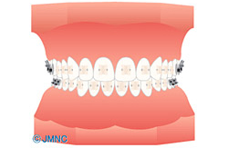 審美ブラケット