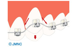 セルフライゲーションブラケット