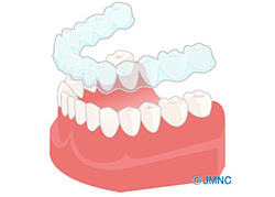 マウスピース矯正